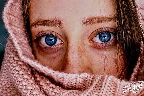 سیاهی زیر چشم